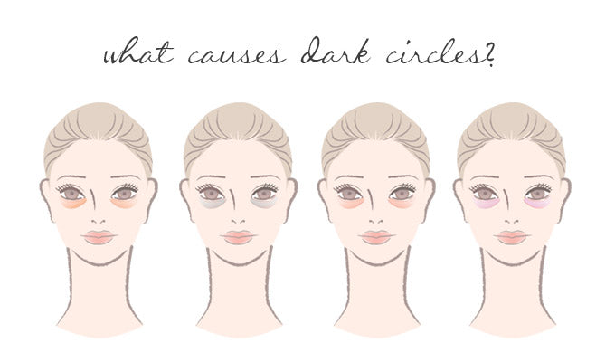 What Causes Dark Circles Under Your Eyes?