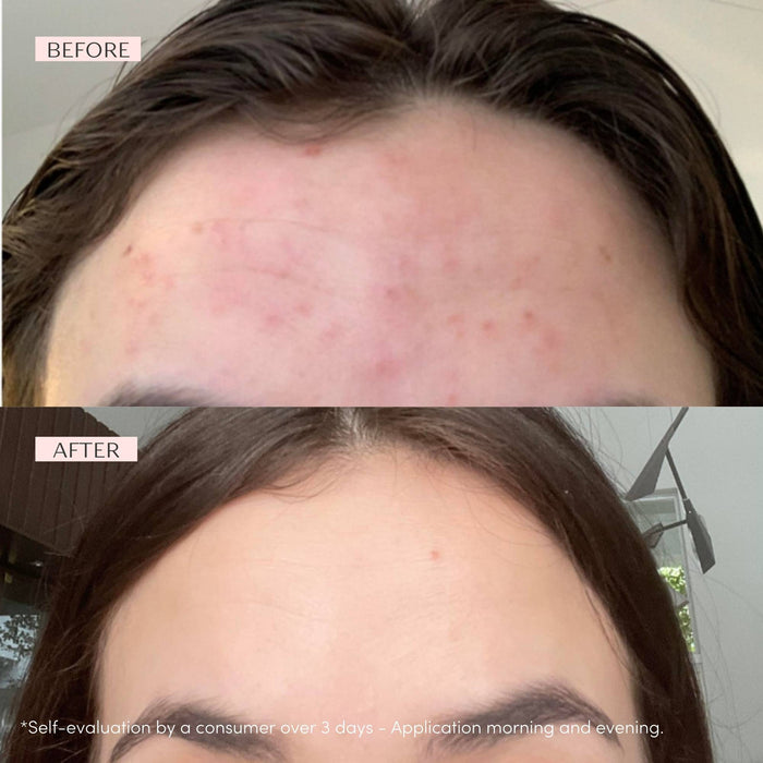 SOS SPOT Roll-On Blemish Treatment