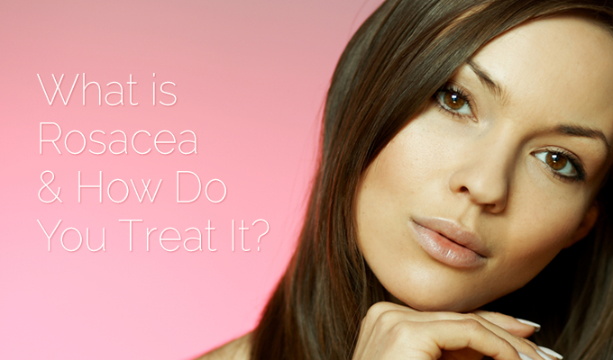 What is Rosacea and How Do You Treat It?